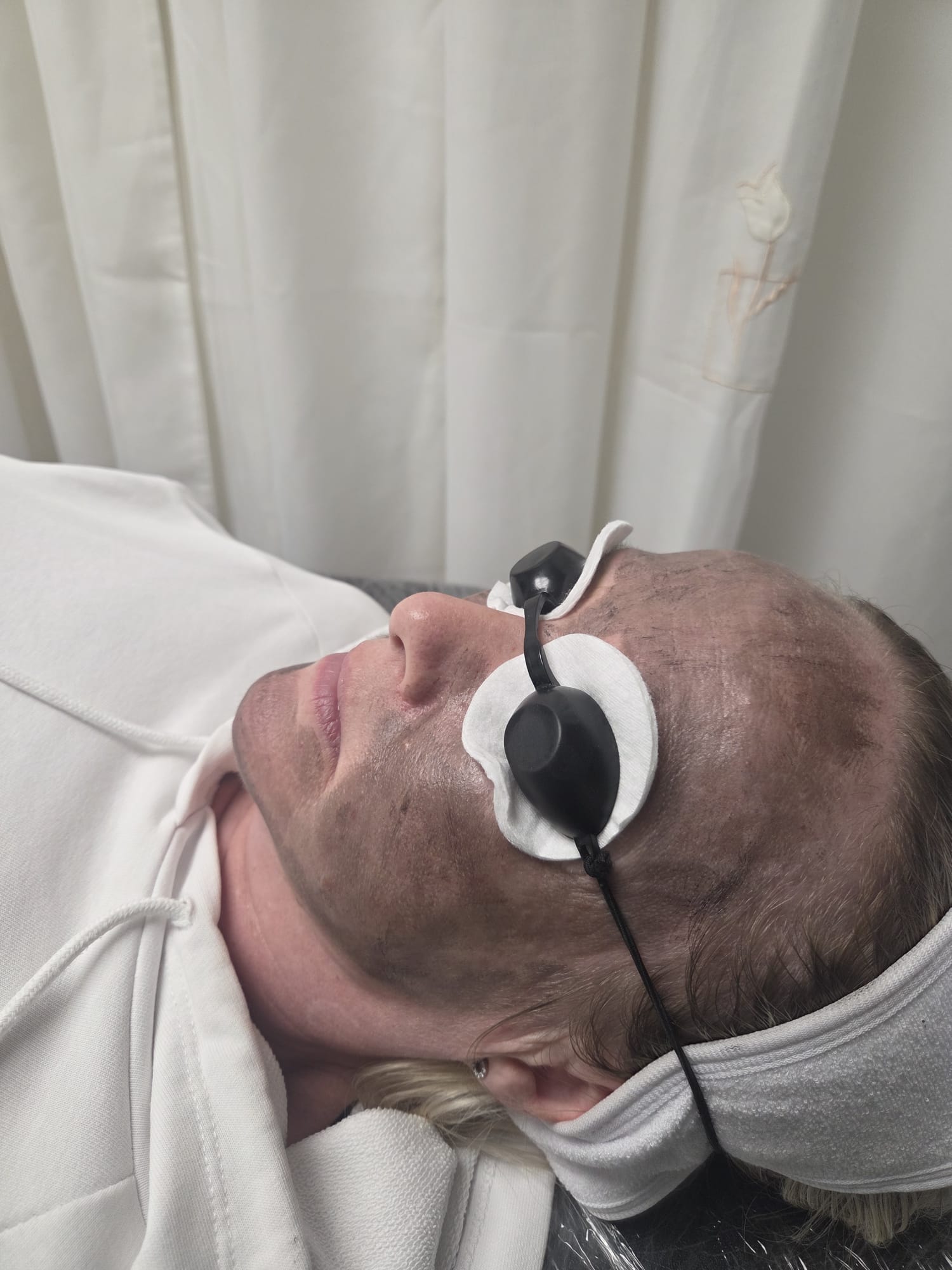 Practical laser training on a live model at Gia Laser Clinic