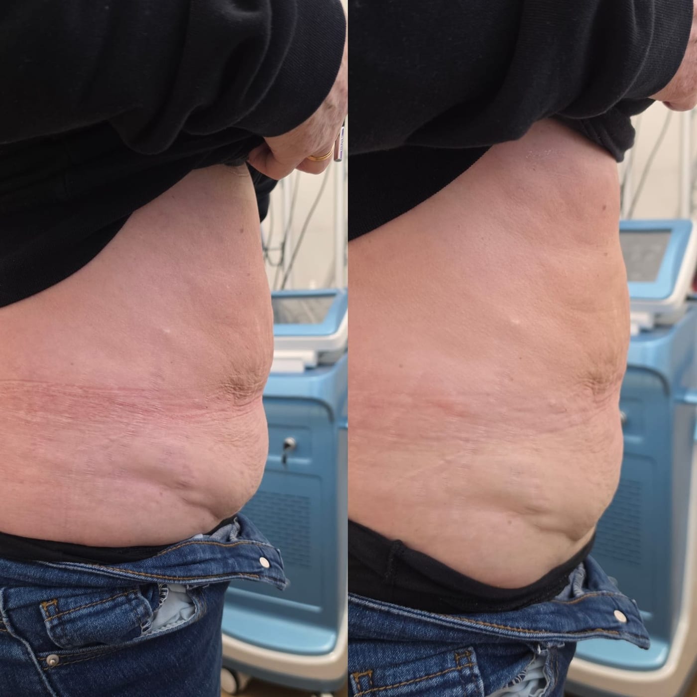 Before and after fat freezing on the stomach