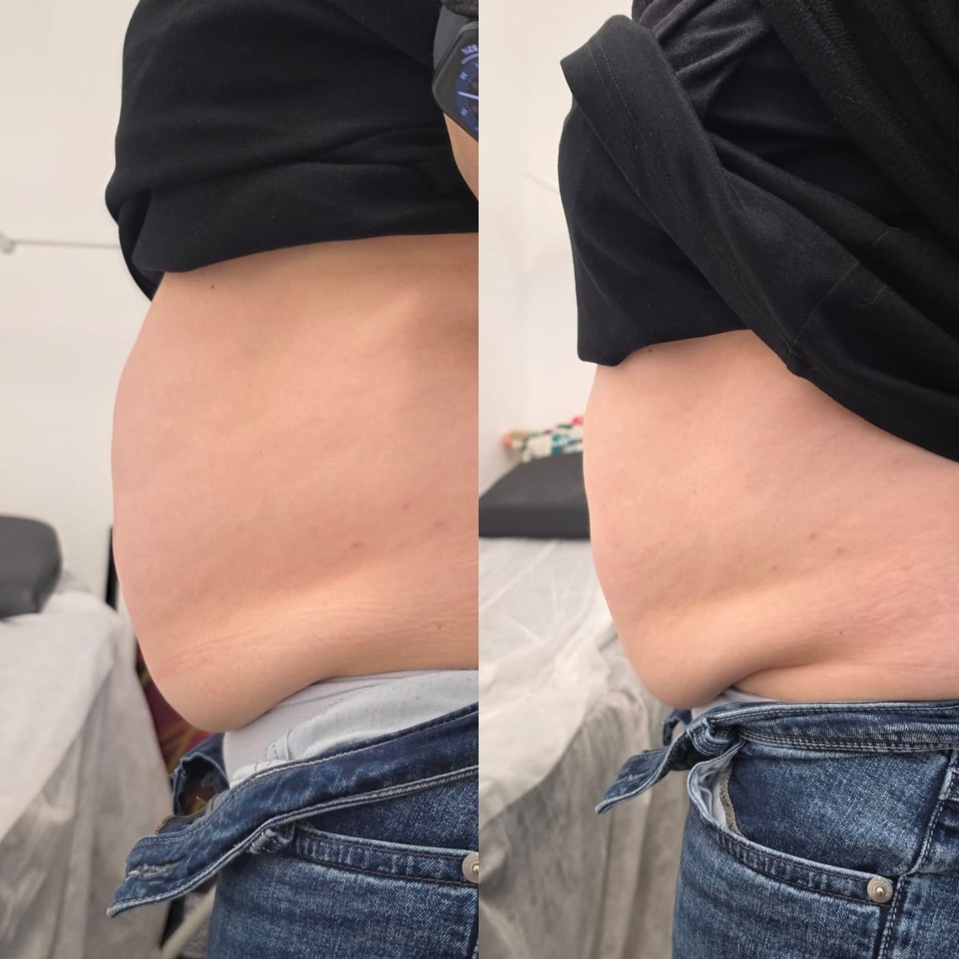 Before and after fat freezing result