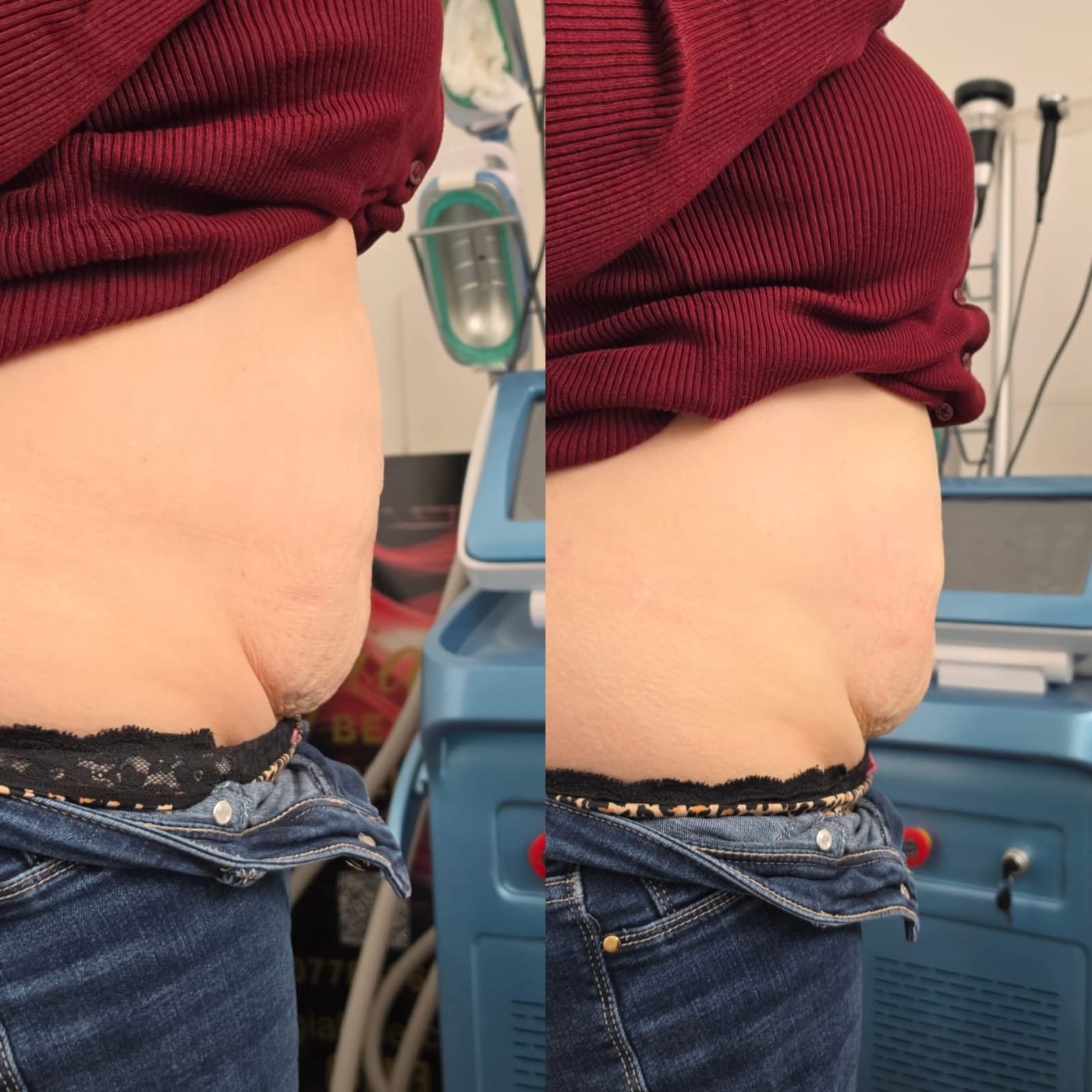 Before and after fat freezing on the abdomen