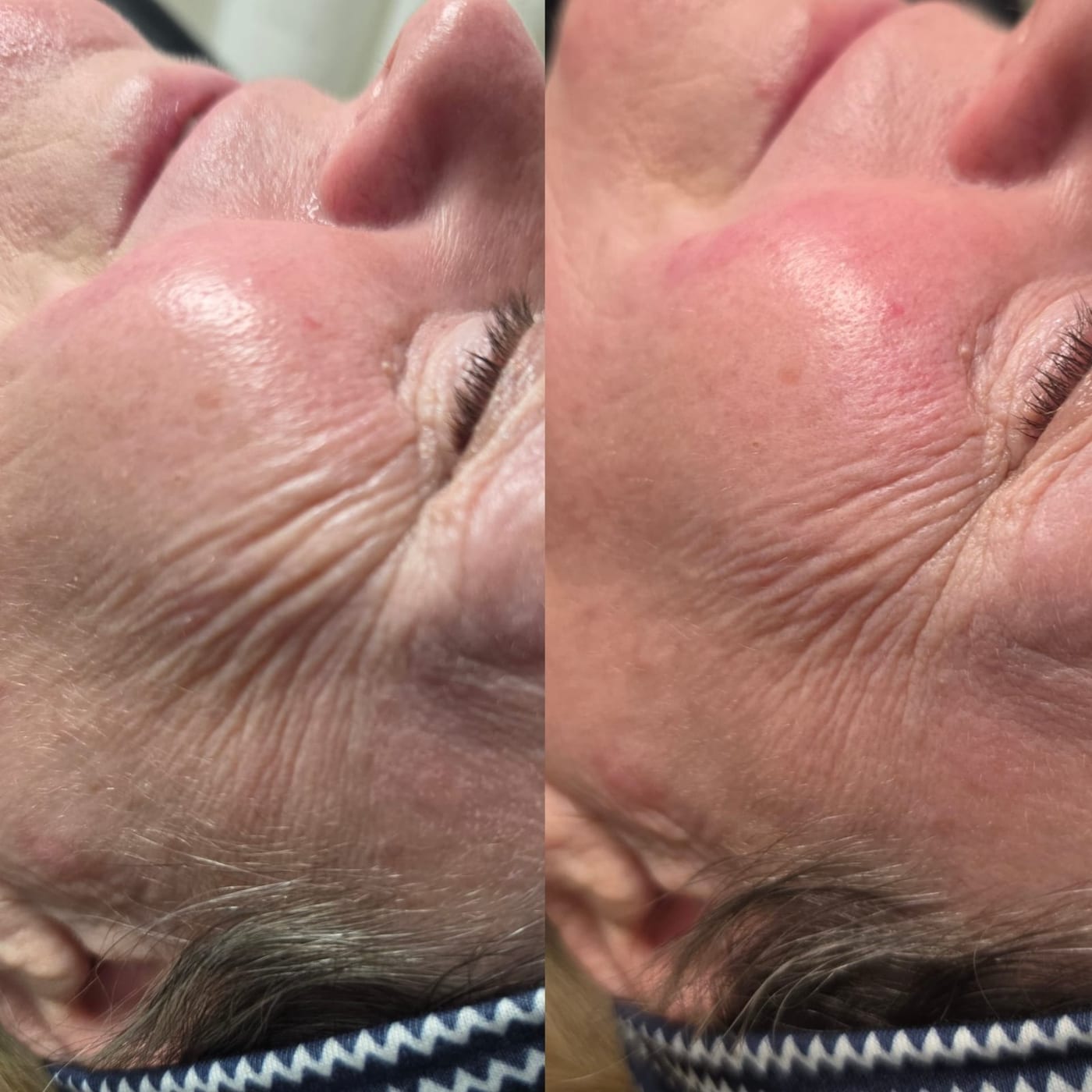 Before and after HIFU on the lower face
