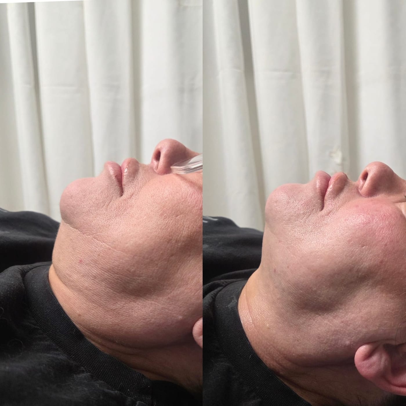 Before and after HIFU result