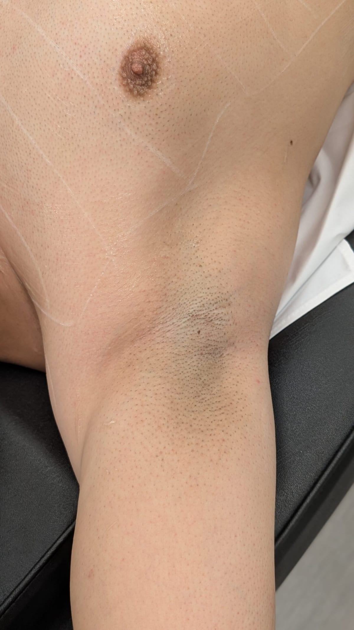 Underarm laser hair removal at Gia Laser Clinic