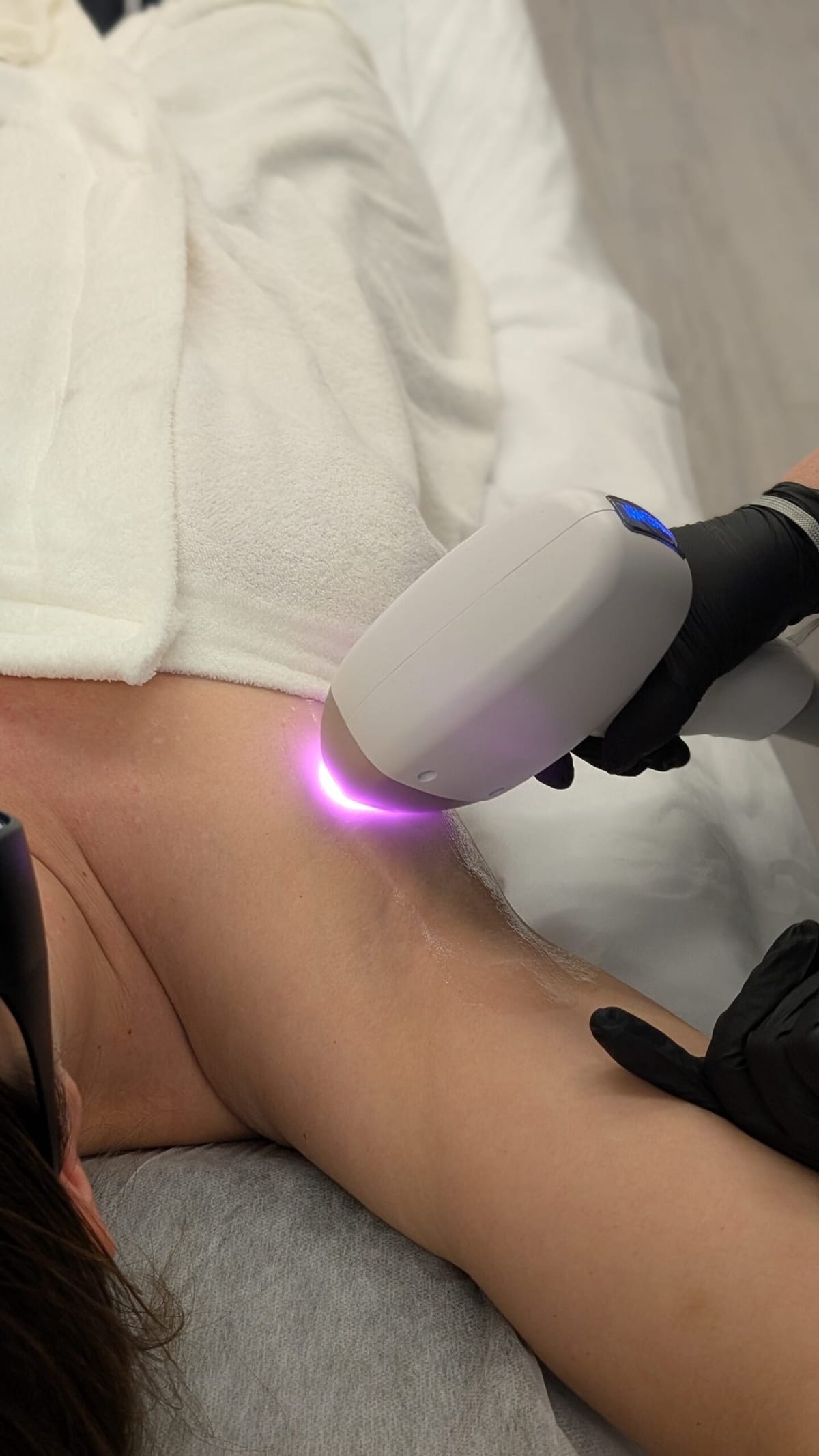 Laser hair removal being carried out at Gia Laser Clinic in Birkenhead